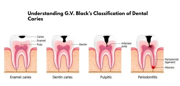 Illustration showing Understanding G.V. Black’s Classification of Dental Caries with enamel caries, dentin caries, pulpitis, and periodontitis stages.